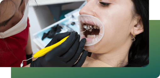 Dentist placing a dental crown on a patient's tooth after root canal treatment to restore function and protection.