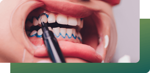 A person’s teeth being whitened with blue gel applied using a tool during the teeth whitening procedure.