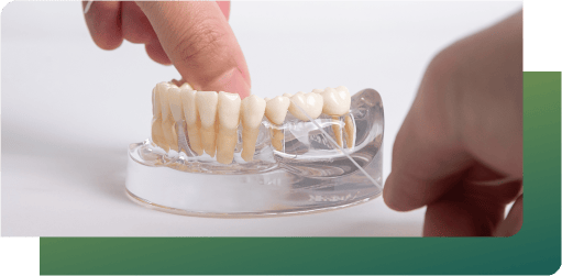 Professional adjust a clear dental retainer on a model, creating personalized tooth bridges that match your natural teeth.