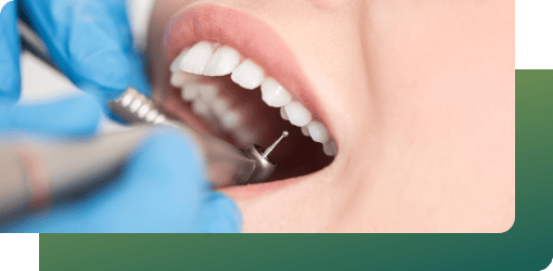 A dentist uses a drill on a patient's teeth, ensuring precise placement of dental bridges and a comfortable fit with high-quality materials.