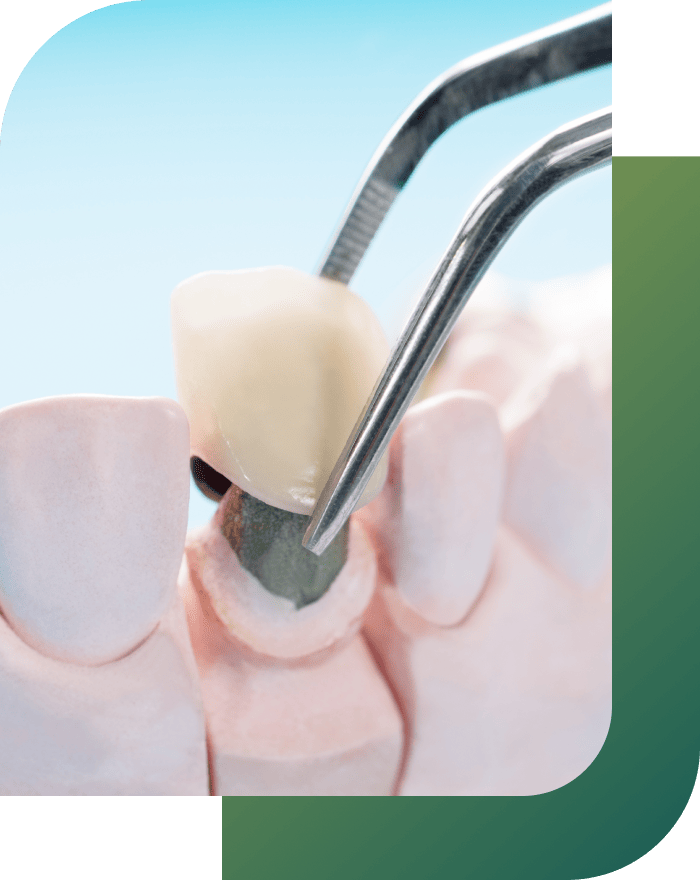 A dental crown procedure on damaged teeth.