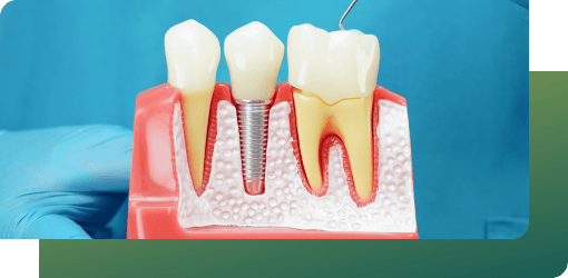 Dental implant model illustrating a lasting and secure solution that blends with natural teeth for a restored, confident smile.