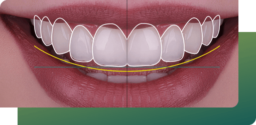 A digital smile design provides a visual preview of your smile makeover, using proportions, photos, and X-rays for accuracy.