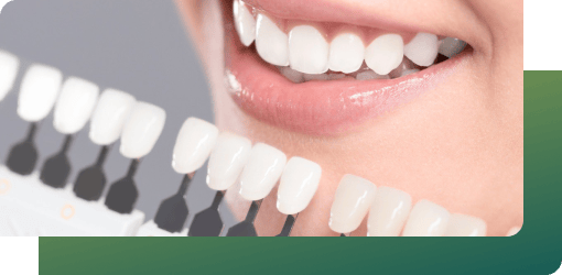 Close-up of a cheerful woman using a shade guide to choose the color for her dental filling.