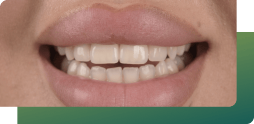 A close-up of a person's healthy teeth and gums, ensuring a flawless fit and secure bond for dental inlays, guaranteeing a durable, natural outcome.
