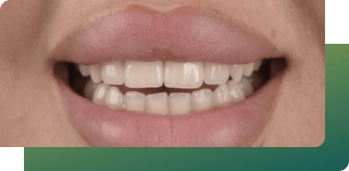 A close-up of a person's healthy teeth and gums, ensuring a flawless fit and secure bond for dental inlays, guaranteeing a durable, natural outcome.