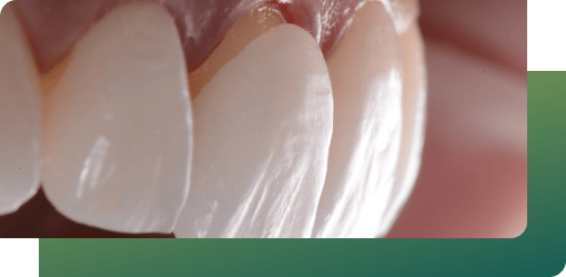 Close-up of porcelain veneers on teeth, illustrating their ability to cover discoloration, gaps, and chips for a perfect smile.