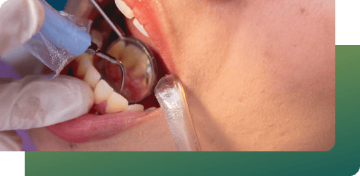 A patient is getting accumulated plaque and tartar removed from their teeth.