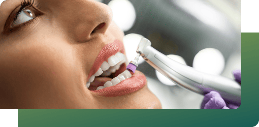 Dentist using a dental tool to clean, etch, and polish a patient's porcelain teeth for better bonding.
