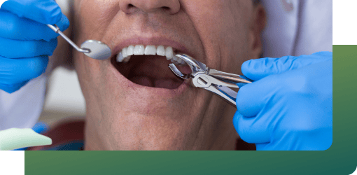 Simple and surgical tooth extraction to minimize pain and improve oral health.