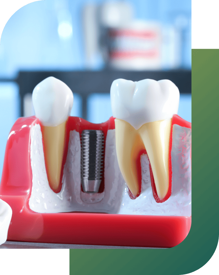 Two teeth being bridged together, with a dental bridge.