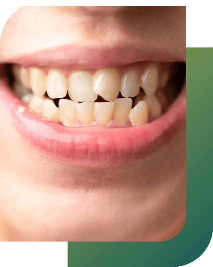 A person smiling with crooked teeth.