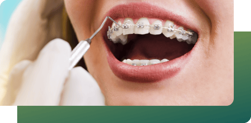 A dentist adjusts metal dental braces with a probe, helping patients of all ages improve their smiles.