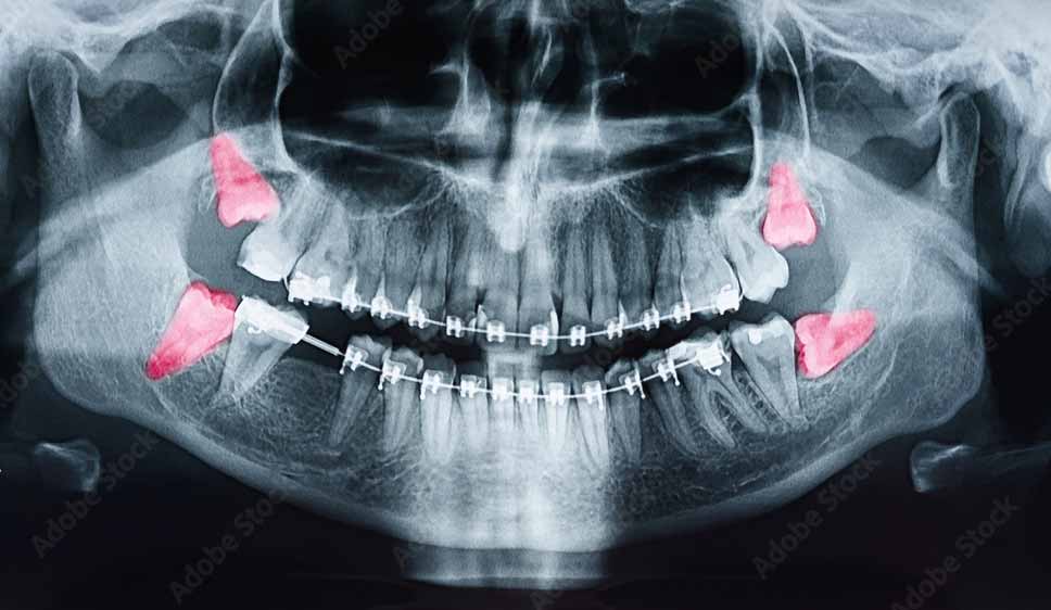 Dental X-ray showing wisdom teeth emerging as the last molars to grow in adults.