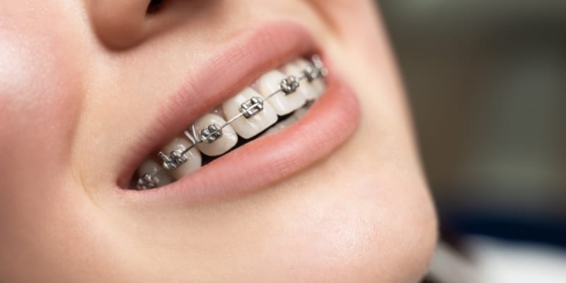 A woman smiles, showing her braces, highlighting the orthodontic treatment.