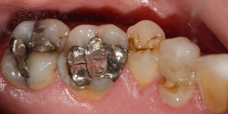A close-up, zoomed-in image of a tooth with a silver amalgam filling.