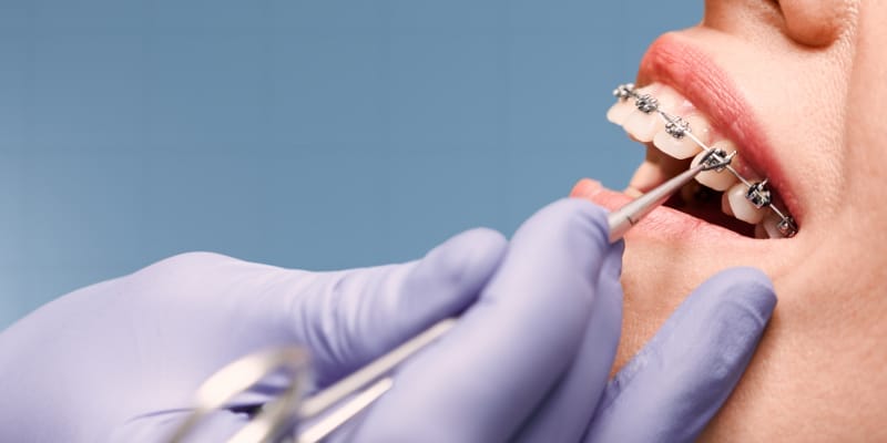 Woman with wired metal braces on teeth receiving treatment at a dental centre.