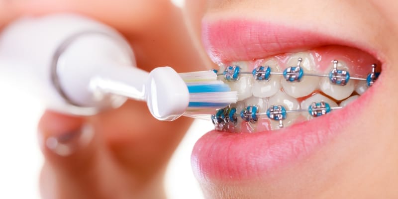 Teen girl with braces brushing teeth, illustrating proper technique for oral hygiene.