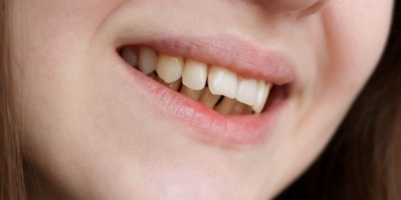 Woman smiling, showing visible dental malocclusion with misaligned teeth.