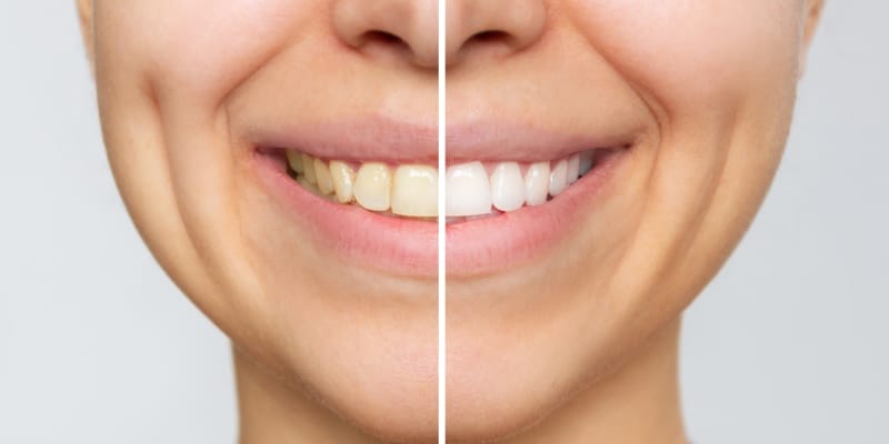 Before and after professional teeth whitening showing visibly brighter teeth.